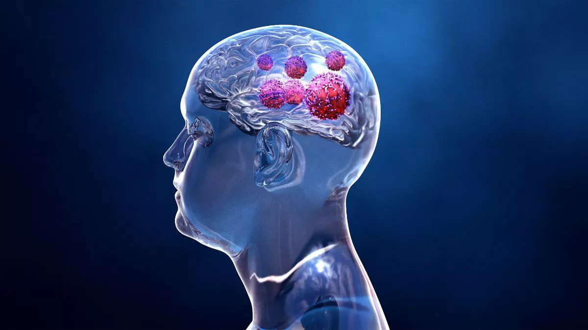 Mengenal Glioma