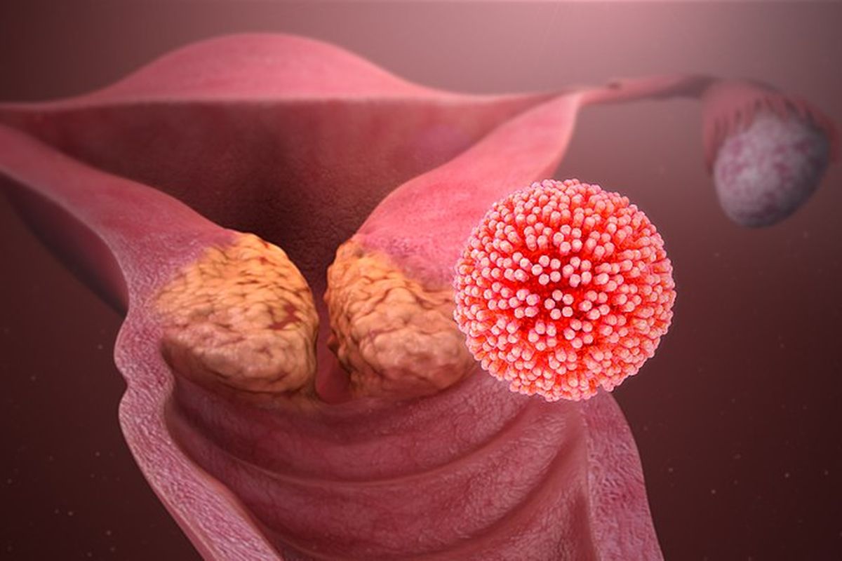 Infeksi HPV
