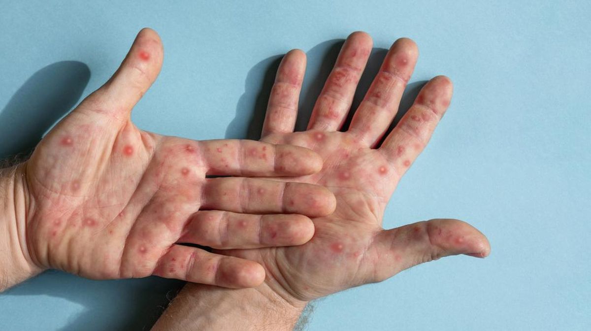 Pneumonia Akibat Campak
